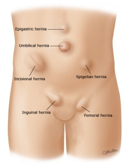 diagram showing the different types of abdominal wall hernias